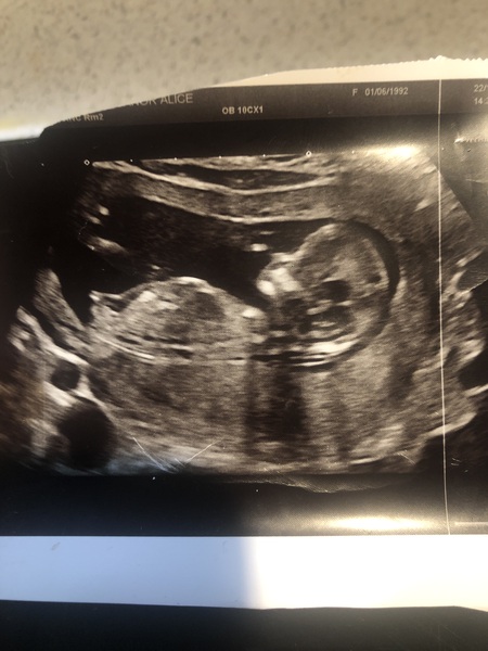 Do you want me to guess the sex? 12 week scans.