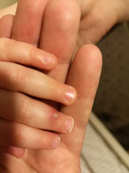 Infected welt