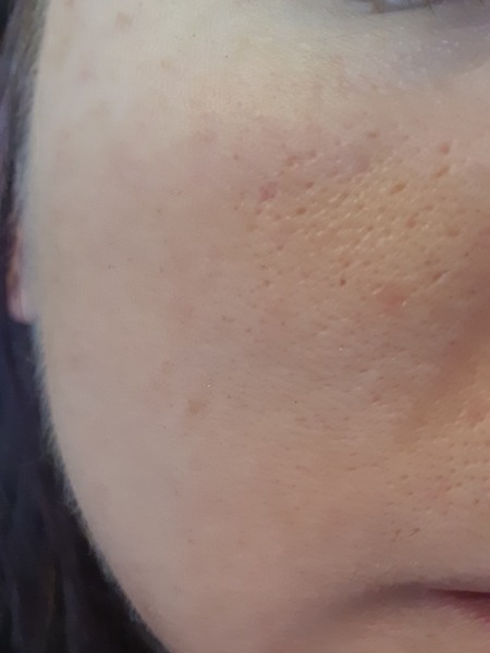 Dermarolling - would it help my skin? (pics included)
