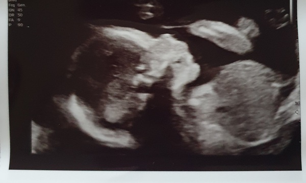 Do you want me to guess the sex? 12 week scans.