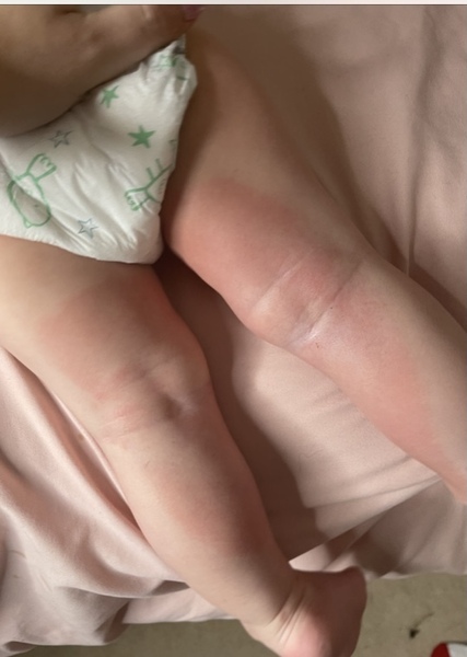 Flat red “rash”