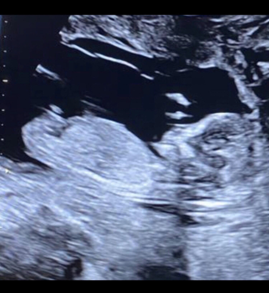 Do you want me to guess the sex? 12 week scans.