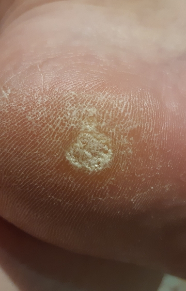 Is this a verruca or a corn/callus?