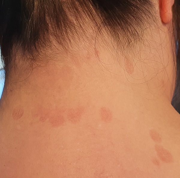 What is this rash please?