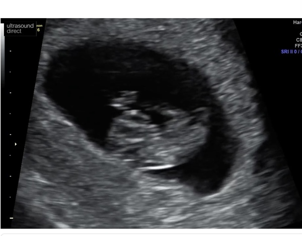 Do you want me to guess the sex? 12 week scans.