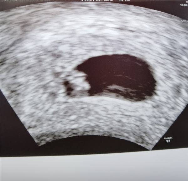 Pregnant straight after miscarriage with no period