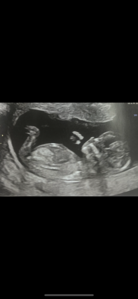 Do you want me to guess the sex? 12 week scans.