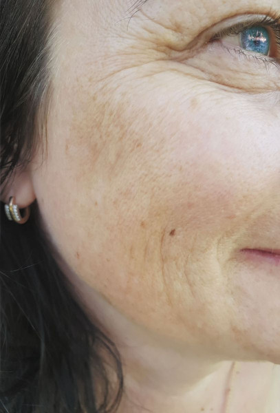 Age spots/discolouration - anything work?