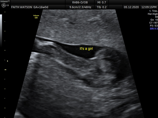 Anyone worried their private gender scan is wrong?