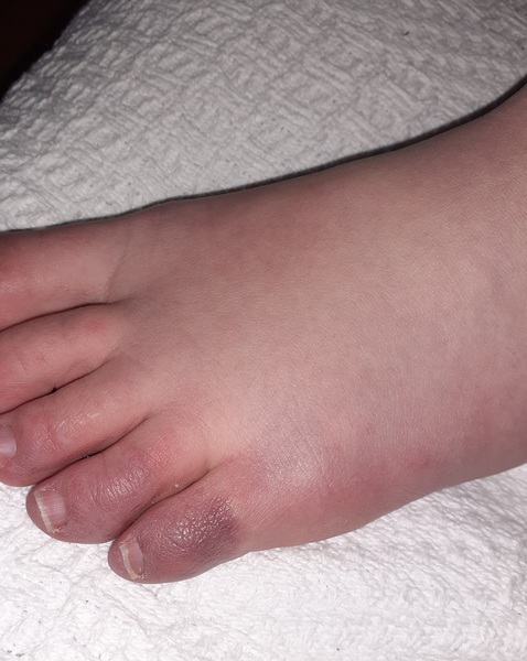 Covid Toe