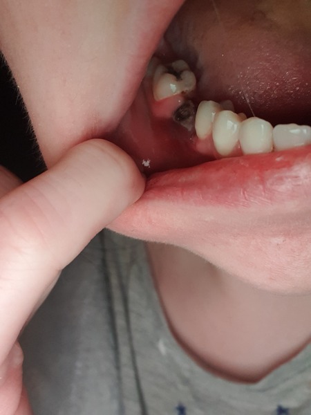 Dry socket?