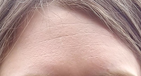 Would you get botox?