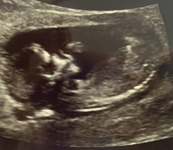 Do you want me to guess the sex? 12 week scans.