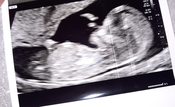 Do you want me to guess the sex? 12 week scans.