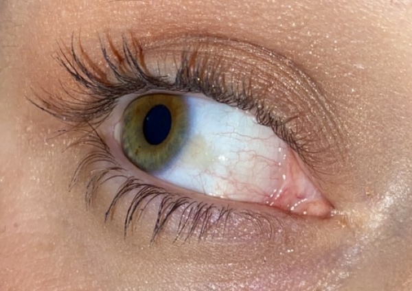 What is this growing on my eye ? I’d it serious ?
