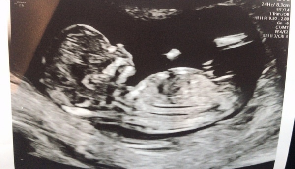 Do you want me to guess the sex? 12 week scans.