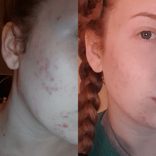 How bad do you think hormonal acne needs to be before seeing a GP?