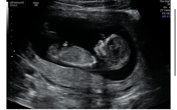 Do you want me to guess the sex? 12 week scans.
