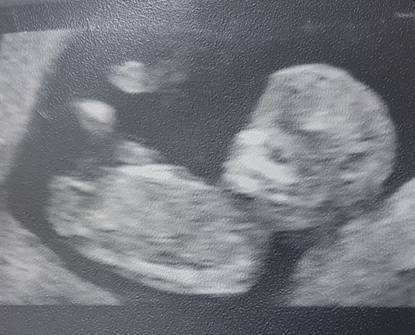 12 week scan - g Or b nub?