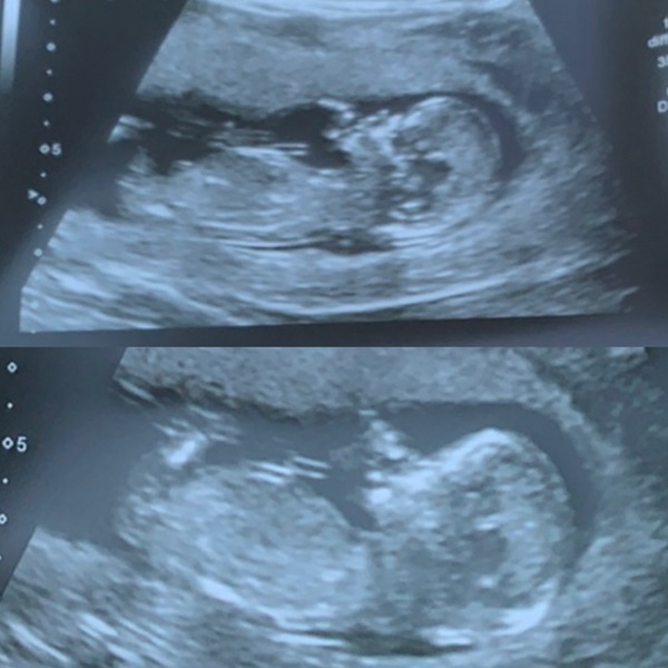 Do you want me to guess the sex? 12 week scans.