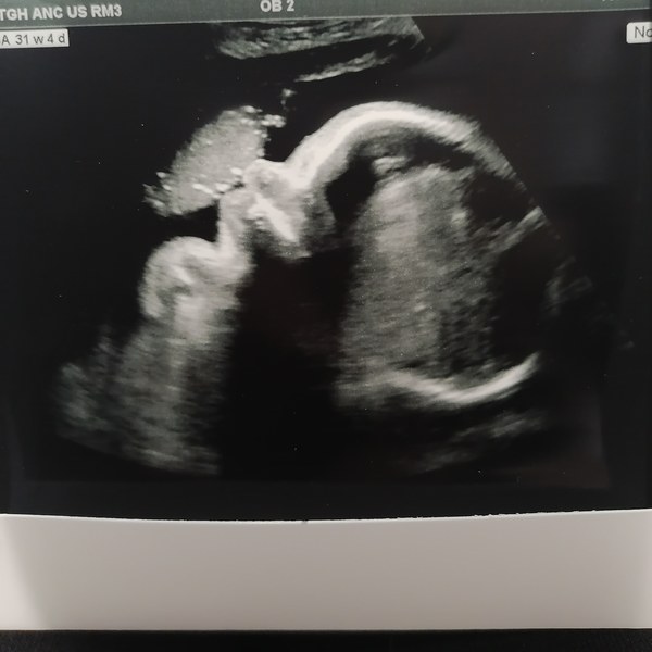 Pregnant After MMC - Thread 5