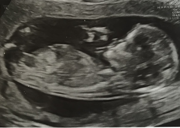 Do you want me to guess the sex? 12 week scans.