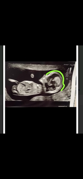Gender guess - I find out tomorrow