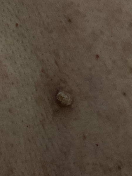 White air filled scab on back for c 1 year