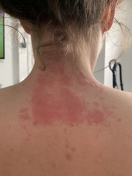 Symptom, itchiness