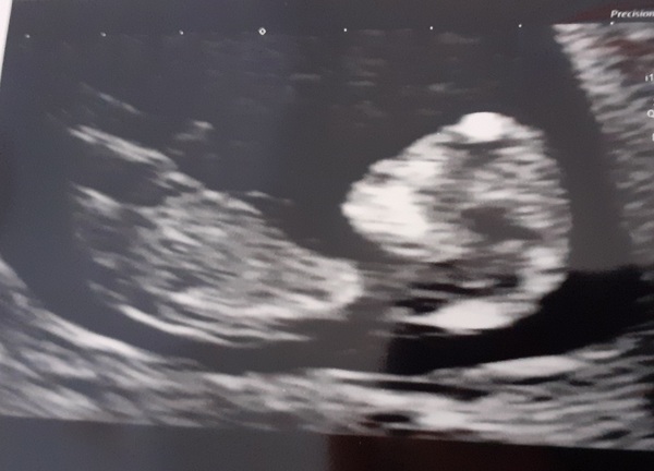 Do you want me to guess the sex? 12 week scans.