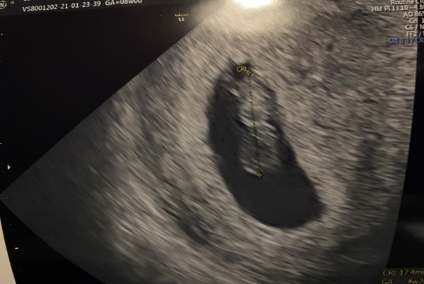 Bleeding, 8 weeks - handhold