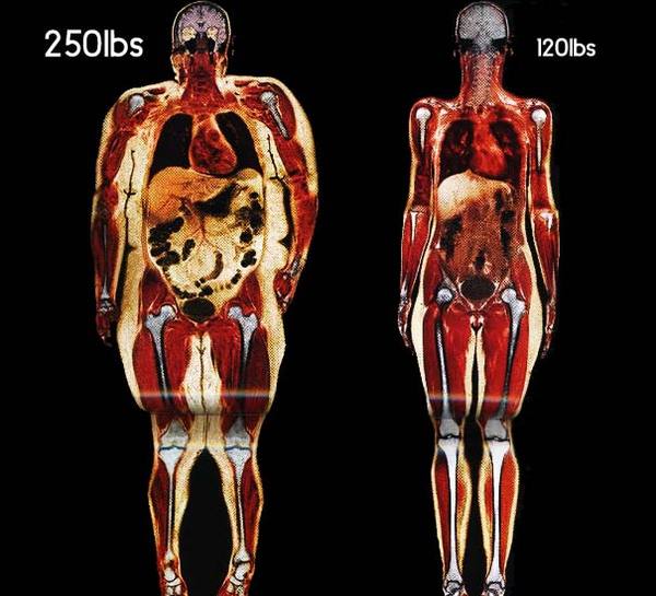 ‘Healthy’ but overweight?