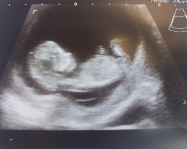 Gender at 12 weeks+4?