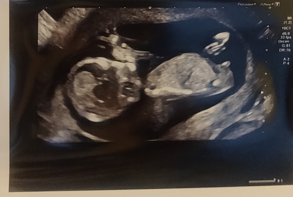 Nub guesses 13 weeks