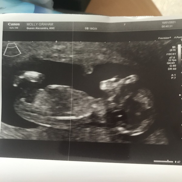 Do you want me to guess the sex? 12 week scans.