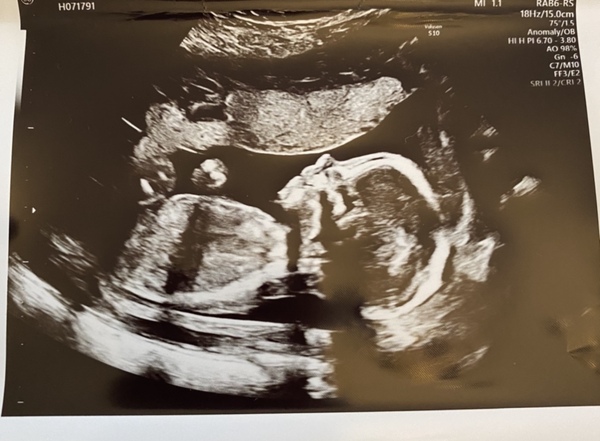 Pregnant After MMC - Thread 5