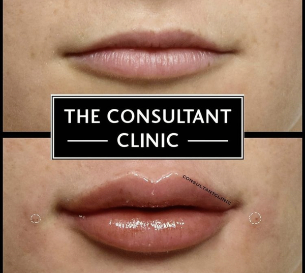 Can fillet in lips ever look natural?