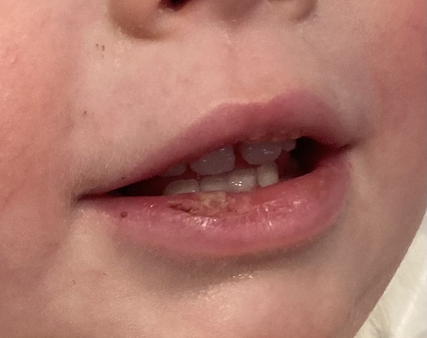 Is this herpes??
