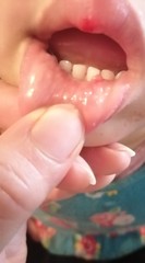 Something on the inside of baby's lower lip (pictures attached)