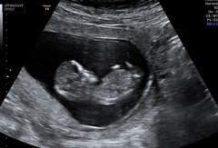 Nub at 12 weeks