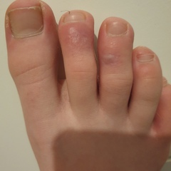 Covid Toe