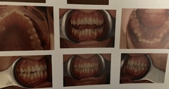 Invisalign