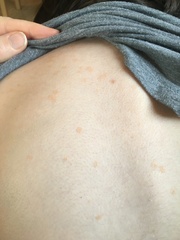 What is this rash?