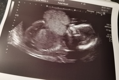 17 weeks Nub theory, help please.