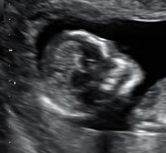 Baby scan has a pointy face and no nose?