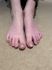 Covid Toes?