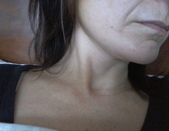 Jowls and jawline