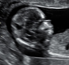 Baby scan has a pointy face and no nose?
