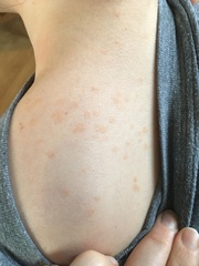 What is this rash?