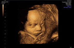 Pregnant After MMC - Thread 4